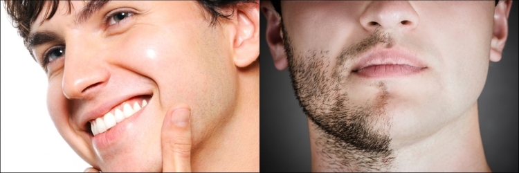 Эпиляция бороды у мужчин
